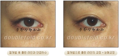 Double Eyelid Revision Surgery at Duhan Plastic Surgery Clinic - Asymmetric Double Eyelids, Pseudoptosis, and Lateral/Lower Canthoplasty image 33