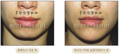 [Duhan Plastic Surgery Clinic Microgenia Correction] - [Chin Microfat Grafting] image 16