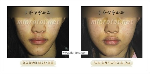 [두한성형외과 경쟁력 윤곽성형] - [볼, 볼살 지방이식] 관련 이미지 15