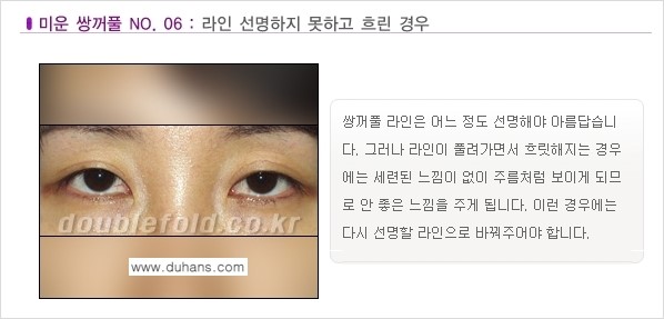 [두한성형외과 경쟁력 눈성형] - [미운 쌍꺼풀이란?] 관련 이미지 7