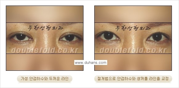 [두한성형외과 NO.1 "극한 눈(쌍꺼풀 재수술)"] - [안검하수(졸린눈매) 재수술 안내 3.] 관련 이미지 9