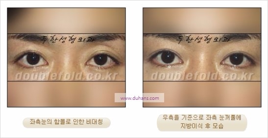 [두한성형외과 경쟁력 눈성형] - [비대칭 쌍꺼풀 라인의 여러 가지 교정 방법] 관련 이미지 19