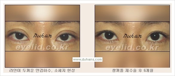 [두한성형외과 경쟁력 눈성형] - [안검하수와 몽고주름에 대한 자주하는 질문과 답변] 관련 이미지 4