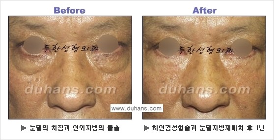 [두한성형외과의 상큼하고 환한 젊은 눈매완성] - [하안검 성형술 ①] 관련 이미지 19