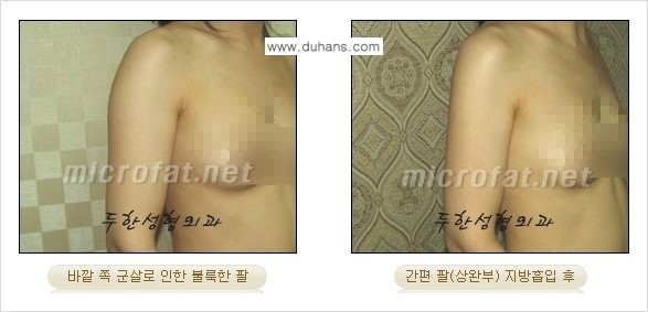 [두한성형외과 간편 지방흡입] - [팔, 팔뚝, 팔뚝살, 상완부 지방흡입 시술의 예] 관련 이미지 4