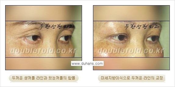 [두한성형외과 경쟁력 눈성형] - [미세지방이식으로 두꺼운 쌍꺼풀 라인의 교정 방법 안내] 관련 이미지 16