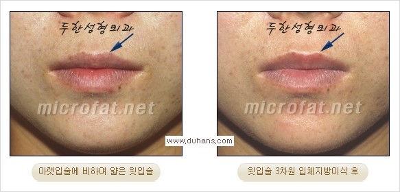 [두한성형외과 경쟁력 미세지방이식] - [입체 미세지방이식으로 주름을 펴면서 볼륨감 있는 입술 만들기] 관련 이미지 10