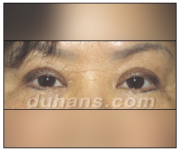 Candidates for Double Eyelid Revision Surgery: Unattractive Double Eyelids, Beautiful Double Eyelids image 6