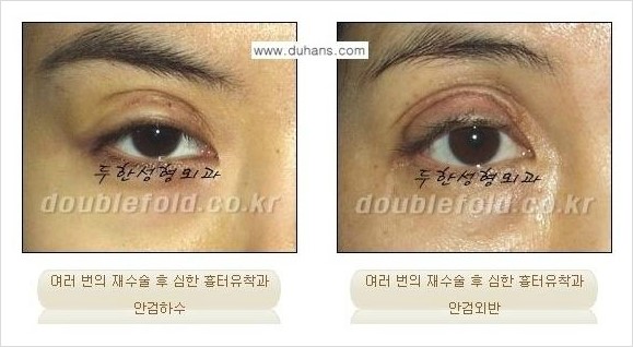 [두한성형외과 경쟁력 눈성형] - [극한의 망가진 쌍꺼풀 복원수술과 일반 쌍꺼풀 재수술과의 차이점 안내] 관련 이미지 1