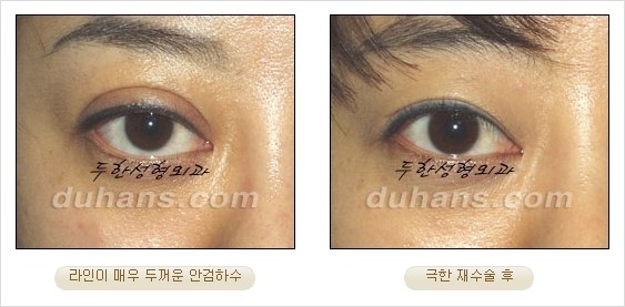 [두한성형외과 경쟁력 쌍꺼풀 재수술 리더 ] - [쌍꺼풀 재수술 과정, 쌍꺼풀 재수술 실패의 원인, 극한 재수술] 관련 이미지 14
