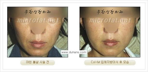 [두한성형외과 경쟁력 미세지방이식] - [상표등록 "Col-fat(콜펫) 지방이식"의 장점 안내] 관련 이미지 9
