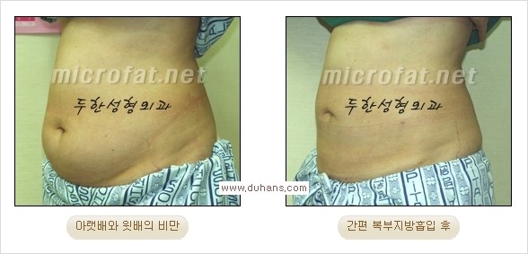 [두한성형외과 경쟁력 간편지방흡입] - [복부(뱃살) 비만 간편지방흡입] 관련 이미지 13