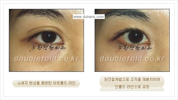 [두한성형외과 경쟁력 쌍꺼풀(눈) 재수술] - [심한 아웃폴드 라인을 인폴드 라인으로의 교정 안내] 관련 이미지 4