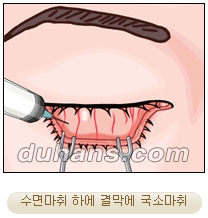 두한성형외과 지방제거 - 눈밑지방, 눈꺼풀지방제거 관련 이미지 14