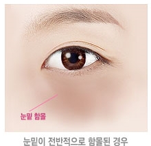 두한성형외과 눈밑수술 - 다크서클 수술 전후 관리 안내 관련 이미지 101