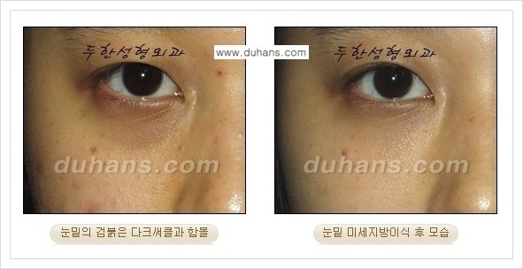 [두한성형외과 경쟁력 눈밑성형] - [다크써클과 눈밑주름을 위한 미세지방이식 안내] 관련 이미지 5