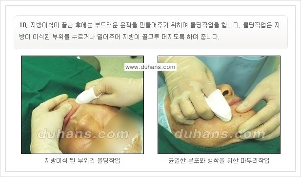 [두한성형외과 경쟁력 미세지방이식] - [부드럽고 아름다운 얼굴선 만들기, 얼굴 미세지방이식 과정 안내] 관련 이미지 9