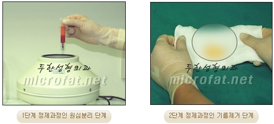 Fat Grafting Leader Duhan Plastic Surgery - Everything About Fat Grafting image 50