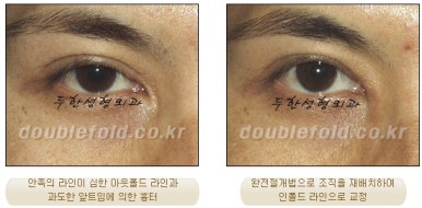 [두한성형외과 쌍커풀재수술] - [심한 소세지눈, 두줄따기, 쌍꺼풀 흉터] 관련 이미지 29