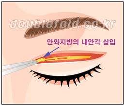 [두한성형외과 쌍수] - [재수술 실패의 원인, 재수술의 성공 요건] 관련 이미지 8