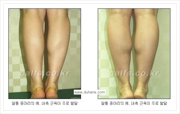 [두한성형외과 경쟁력 멀티종아리성형] - [나에게 맞는 종아리 시술 방법과 종류 안내 ①] 관련 이미지 4