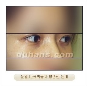 [두한성형외과 경쟁력 눈밑성형] - [눈밑애교살 시술을 위한 미세지방이식] 관련 이미지 3