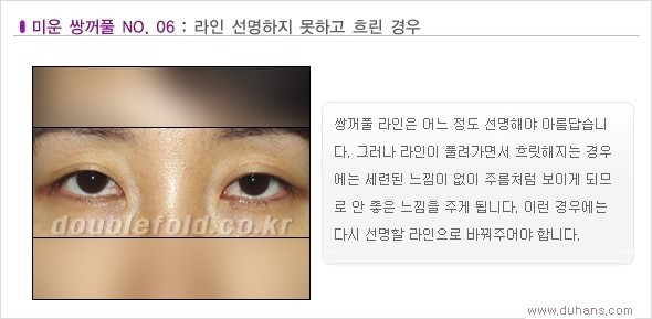 [두한성형외과 경쟁력 쌍꺼풀 재수술, 극한 눈재수술] - [Dr. 컬럼 - 재수술의 목표] 관련 이미지 9