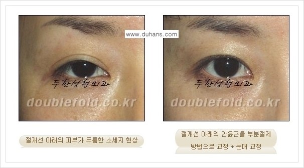 [두한성형외과 경쟁력 쌍꺼풀 재수술, 극한 재수술] - [쌍꺼풀 절개선 아래가 두툼한 소세지 쌍꺼풀의 교정 안내] 관련 이미지 4