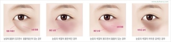 [두한성형외과 경쟁력 지방이식] - [다크써클, 눈​밑주름의 교정] 관련 이미지 52