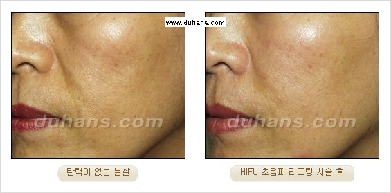 [두한성형외과 경쟁력 주름성형] - [주름제거를 위한 리프팅] 관련 이미지 45