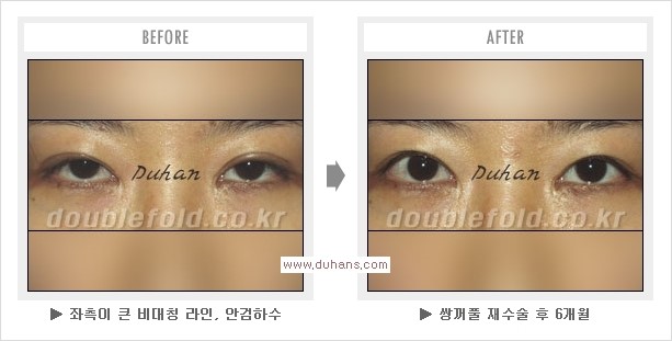 [두한성형외과 쌍꺼풀 재수술, 극한 눈재수술] - [재수술에 대한 자주하는 질문과 답변 안내] 관련 이미지 8