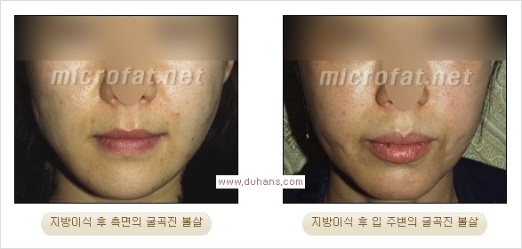 [두한성형외과 경쟁력 미세지방이식] - [미세지방이식, 자가지방이식, 지방이식, 지방주입에 대한 잘못된 정보] 관련 이미지 22