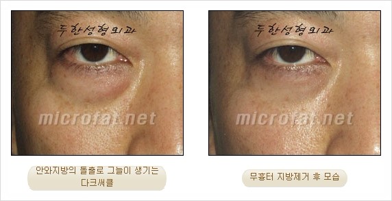 [두한성형외과 쌍커풀수술] - [눈성형 방법에 대한 자주하는 질문과 답변] 관련 이미지 188