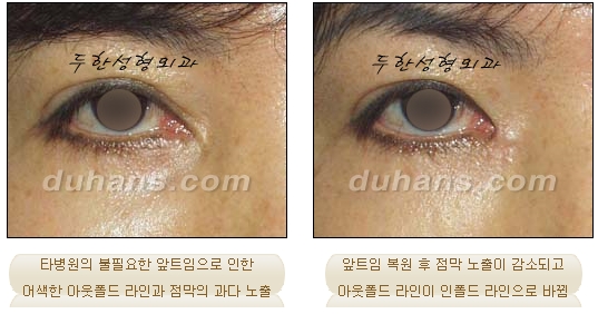 [Doohan Plastic Surgery Double Eyelid Revision Surgery] - [Double Eyelid Revision Surgery Process] image 19