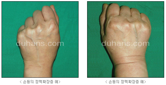 [두한성형외과 정맥류] - [하지정맥류, 정맥확장증, 혈관확장증] 관련 이미지 47