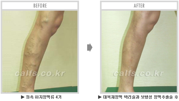 [종아리성형 두한성형외과] - [종아리수술에 대한 자주하는 질문과 답변 모음] 관련 이미지 18