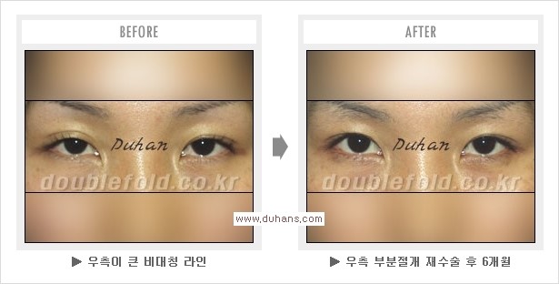 [두한성형외과 경쟁력 쌍꺼풀 재수술, 극한 눈재수술] - [쌍꺼풀 재수술을 위한 검사와 테스트] 관련 이미지 10