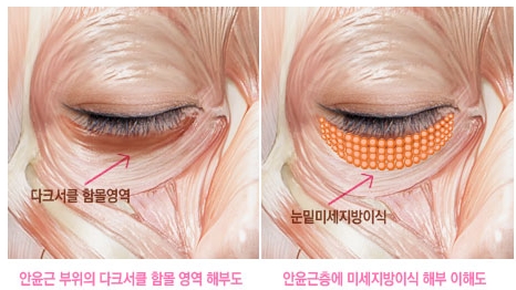 [두한성형외과 다크서클] - [다크서클 콜펫지방이식] 관련 이미지 16
