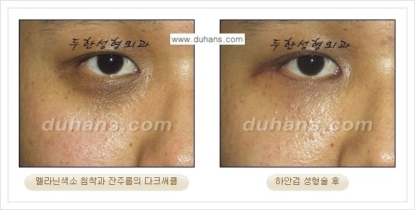 [두한성형외과 경쟁력 눈성형] - [젊은 눈매로의 복원 안검성형] 관련 이미지 38