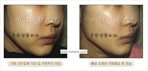 ​[두한성형외과 가을엔 지방흡입을] - [볼살, 눈밑, 턱선 초음파 미세지방흡입] 관련 이미지 3