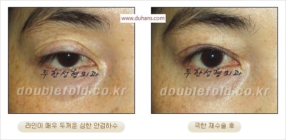 [두한성형외과 경쟁력 쌍꺼풀 재수술] - [두꺼운 라인을 교정하는 극한 재수술(Extreme Rroperation)] 관련 이미지 14