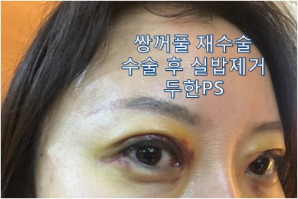 [두한성형외과-쌍꺼풀 재수술] #인아웃라인#쌍꺼풀재수술 관련 이미지 3