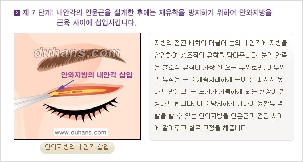 [두한성형외과 경쟁력 눈성형] - [쌍꺼풀 재수술 방법 - 완전절개법(Full incision method) 과정 안내] 관련 이미지 8