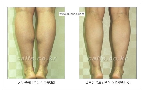 [두한성형외과 경쟁력 멀티종아리성형] - [나에게 맞는 종아리성형 방법의 종류 안내 2.] 관련 이미지 6