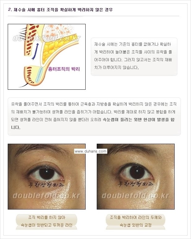 [두한성형외과 경쟁력 쌍꺼풀 재수술, 극한 재수술] - [쌍꺼풀 재수술 실패 원인(Cause of reoperation fail) 안내] 관련 이미지 2