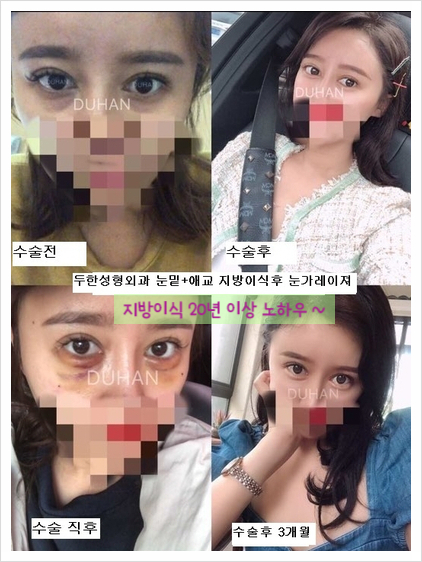 이마성형 두한성형외과 - 이마주름, 이마지방이식 관련 이미지 17