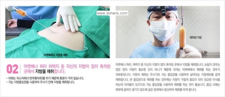 [두한성형외과 FOCUS 눈밑성형] - [다크써클의 치료방법 -  콜펫(Col-fat) 눈밑 미세지방이식 ③] 관련 이미지 7