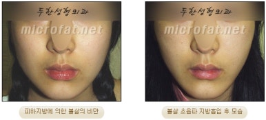 Facial Fat Liposuction at Duhan Plastic Surgery - Cheek Fat Liposuction, Jawline Liposuction, Under-Eye Fat Liposuction image 32