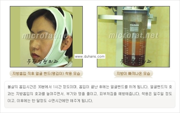 [두한성형외과 겨울엔 지방흡입을] - [통통한 볼살, 두툼한 턱선의 지방흡입 2.] 관련 이미지 5