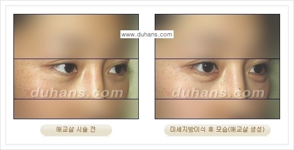 [두한성형외과 경쟁력 눈밑성형] - [눈밑 애교살 시술을 위한 미세지방이식 안내] 관련 이미지 4